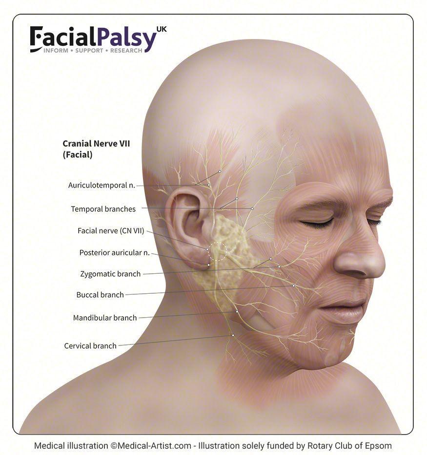 Ramsey hunt facial