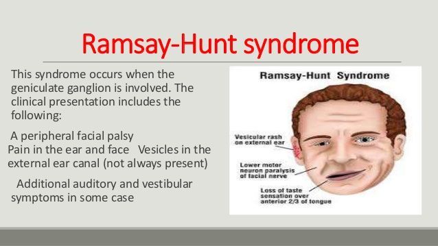 best of Facial Ramsey hunt