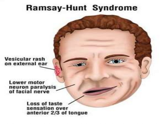 best of Facial Ramsey hunt